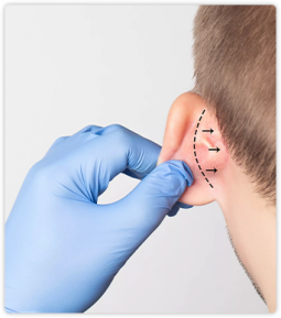 Otoplastia